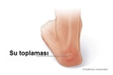 Topuk Su Toplaması Belirtileri ve Tedavisi