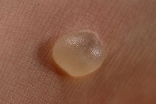 Vücudun Su Toplaması Belirtileri ve Tedavisi