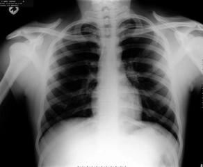 Akciğerde Su Toplanması Bitkisel Tedavisi