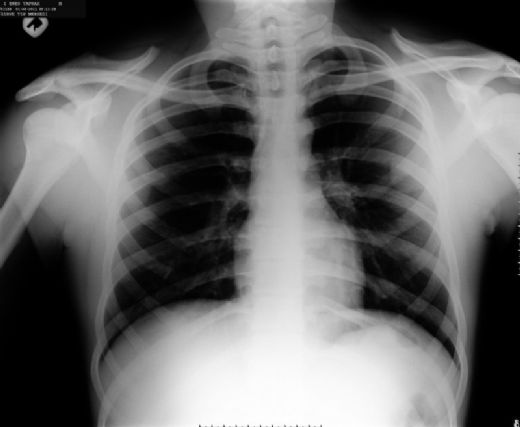 Akciğerde Su Toplanması Bitkisel Tedavisi