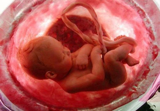 Anne Karnında Bebeğin Karnında Su Toplaması