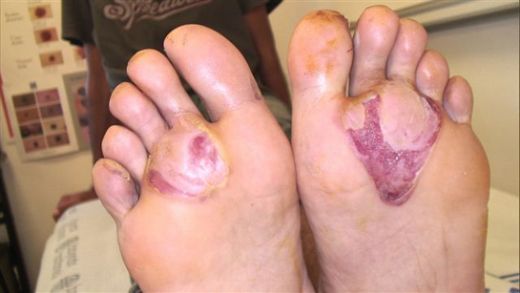 Ayak Altı Su Toplaması ve Kaşıntı Belirtileri ve Tedavisi