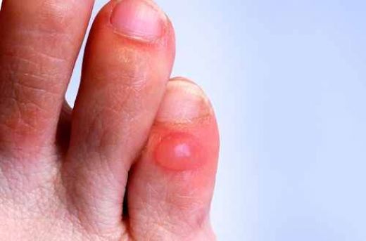 Ayak Parmağı Su Toplaması Belirtileri ve Tedavisi