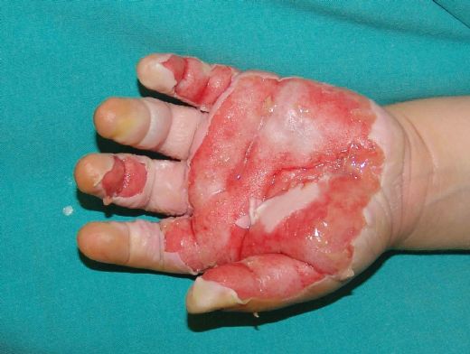 Bebeklerde Yanık ve Su Toplaması Belirtileri ve Tedavisi