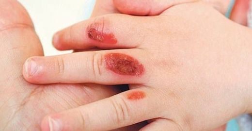 Ciltte Su Toplaması Nasıl Geçer?