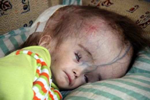 Kafada Su Toplaması Belirtileri ve Tedavisi