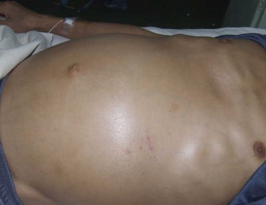 Kanserde Karında Su Toplanması Belirtileri ve Tedavisi