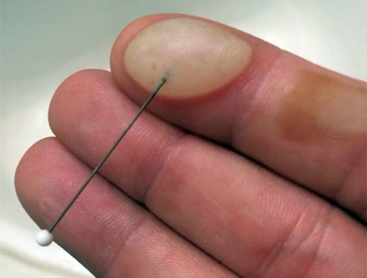 Parmakta Su Toplaması Nasıl Geçer?