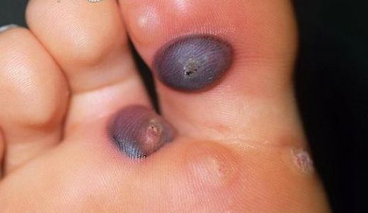 Siğil Su Toplaması Belirtileri ve Tedavisi