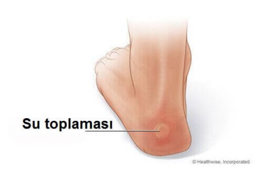 Topuk Su Toplaması Belirtileri ve Tedavisi