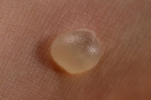 Vücudun Su Toplaması Belirtileri ve Tedavisi