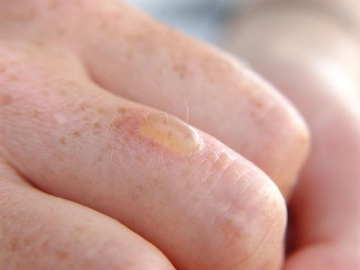 Yanık Sonrası Su Toplaması Belirtileri ve Tedavisi